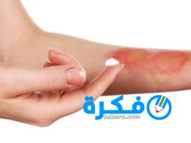 كريم بينتابورن Pentaburn لعلاج الحروق والجروح 4 burn skin cream Custom