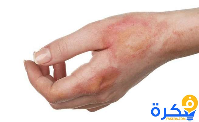 شرح خطوات إزالة أثار الحروق القديمة بالأعشاب 8 e01b3208b57554d9229e2bff1a91b1be