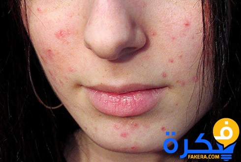 شرح خطوات علاج التهابات الوجه 2 9e82a26933c11dd1