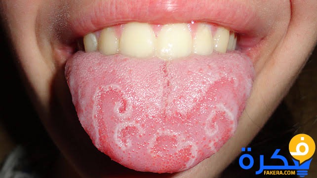 شرح خطوات علاج التهابات اللسان 3 images 5