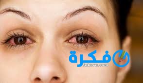طرق علاج التهابات العين Ophthalmitis 19 Ophthalmitis