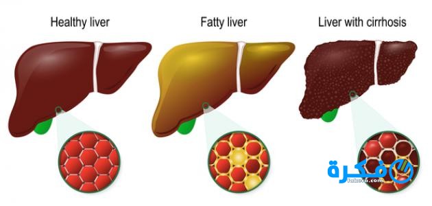 اسباب و علاج تلف الكبد 7 التليف الكبدى