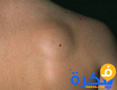 علاج الكيس الدهنى 6 5d6ae1aab00129aae555429f558e5351