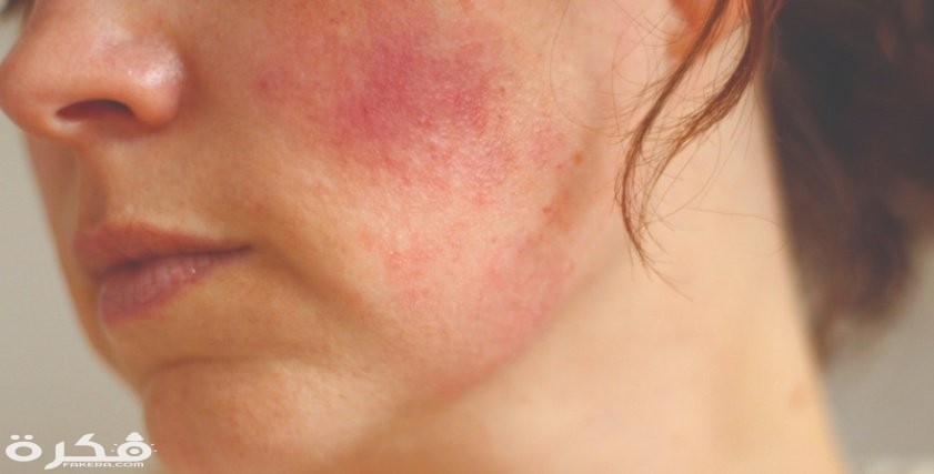 علاج تسلخات الجلد 2 علاج