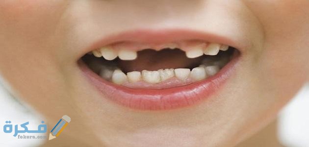 تفسير حلم سقوط الاسنان