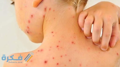 61 010452 smallpox causes symptoms methods prevention 2