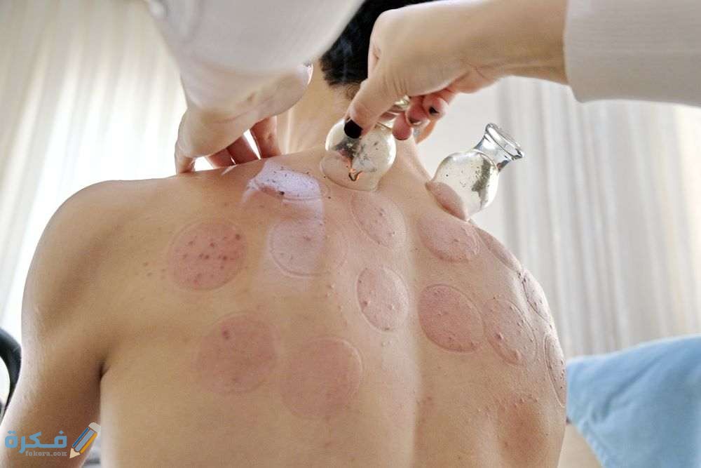 الحجامة الجافة