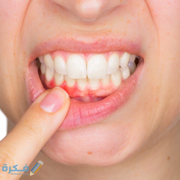 how to treat bleeding gums 2