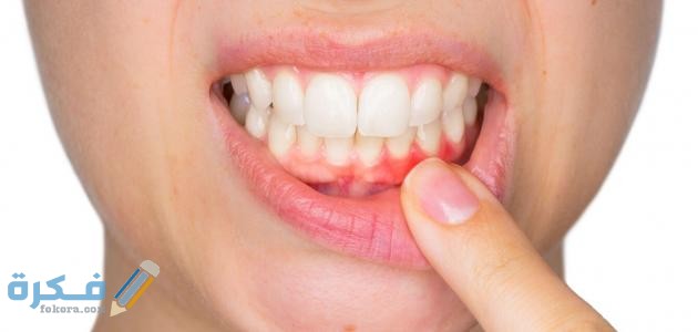 علاج التهاب اللثة والانتفاخ