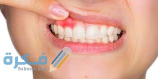 علاج خراج الأسنان المزمن في المنزل 5 علاج خراج الأسنان المزمن في المنزل