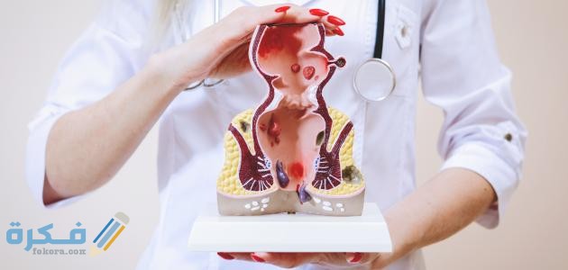 ما هو افضل مرهم لعلاج البواسير الخارجية ؟ 4 ما هو أفضل مرهم لعلاج البواسير الخارجية ؟