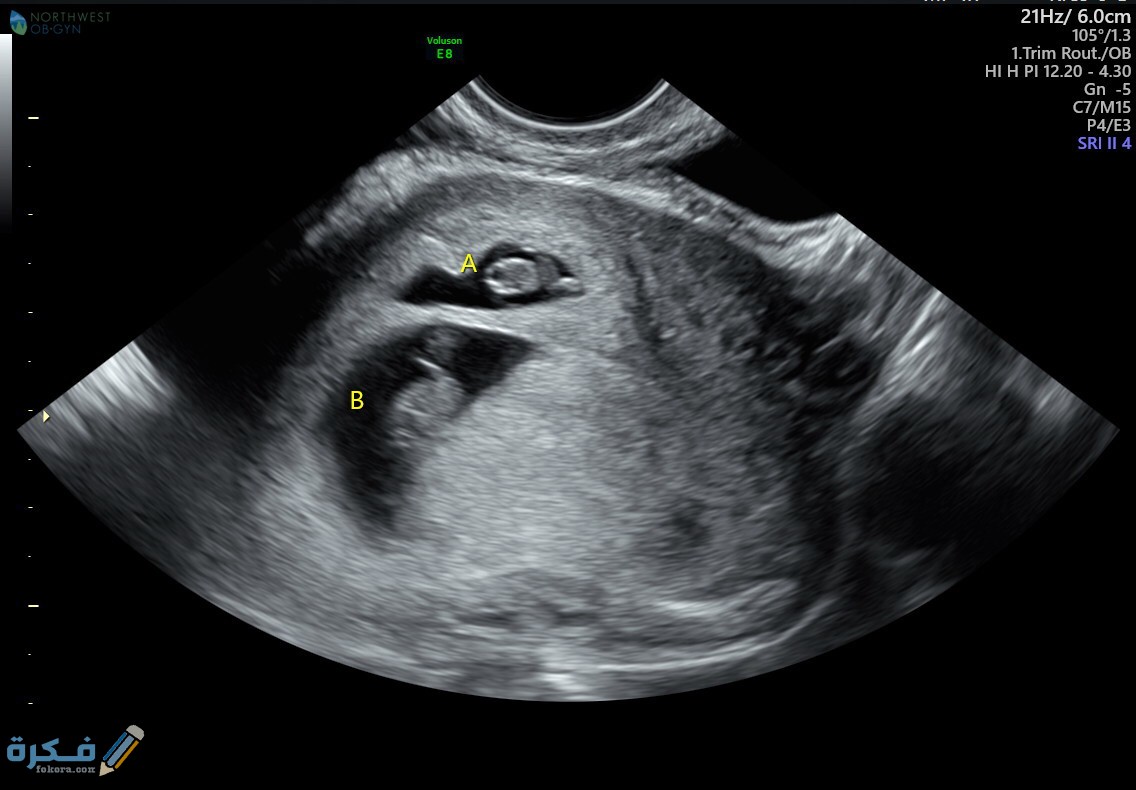 اسباب ظاهرة التوأم الشبح