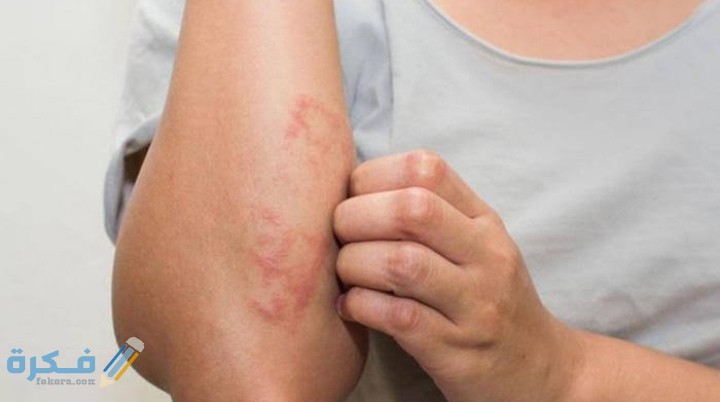 اسماء افضل مضاد حيوي لعلاج التهابات الجلد 10 IMG ٢٠٢١٠٢١٢ ١٨١١٤٩