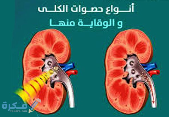 شرح خطوات علاج حصوة الكلى 6 ملم وشرح خطوات الوقاية منها 2 علاج حصوات الكلى الصغيرة