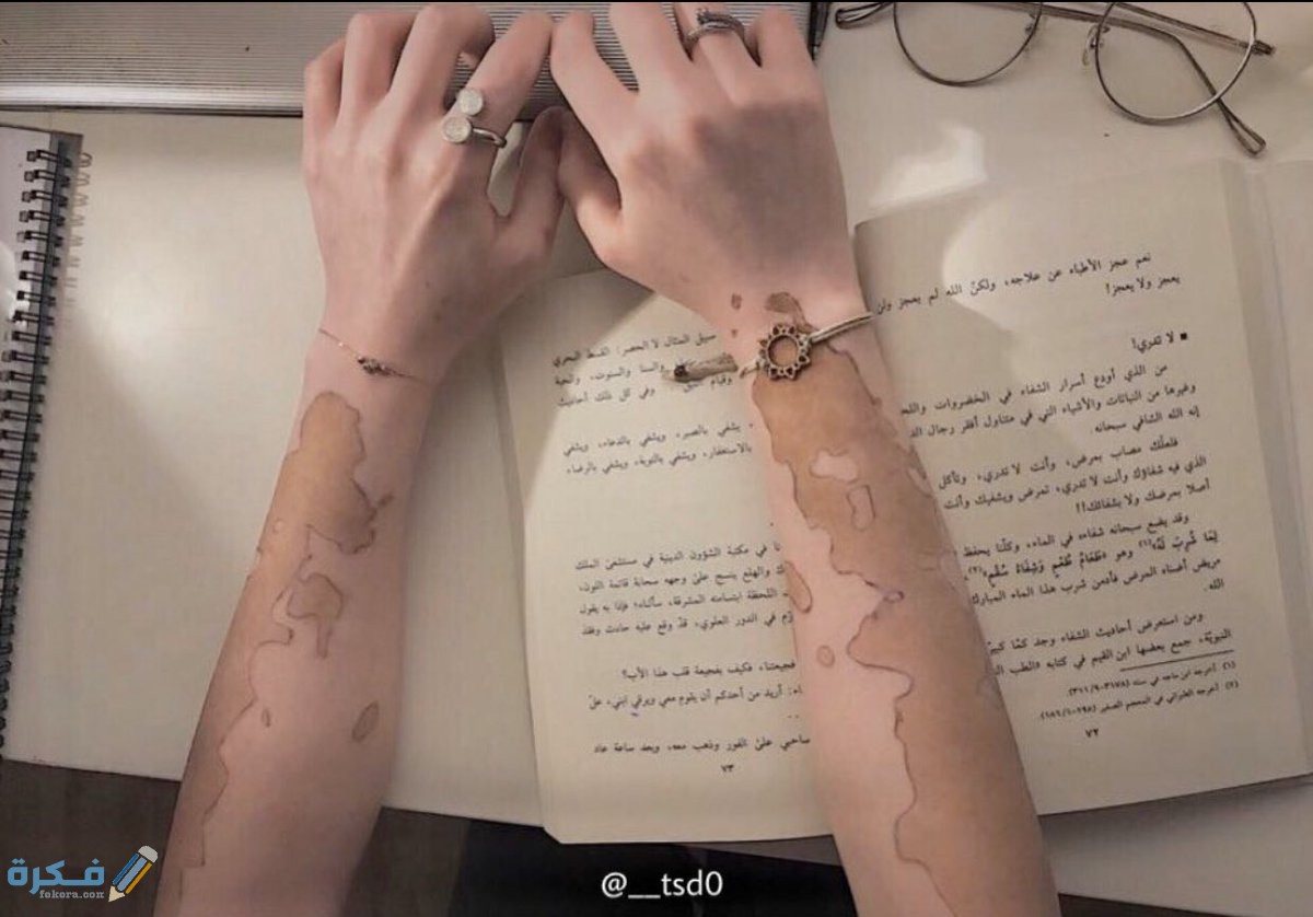 تجربتي في علاج البهاق بالليزر