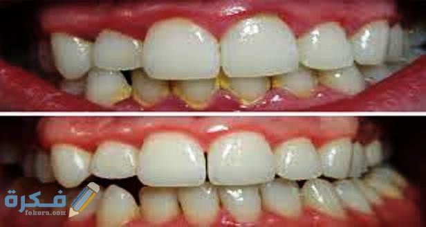 تجربتي مع إزالة الجير الأسنان 8 اسباب تكون جير الاسنان