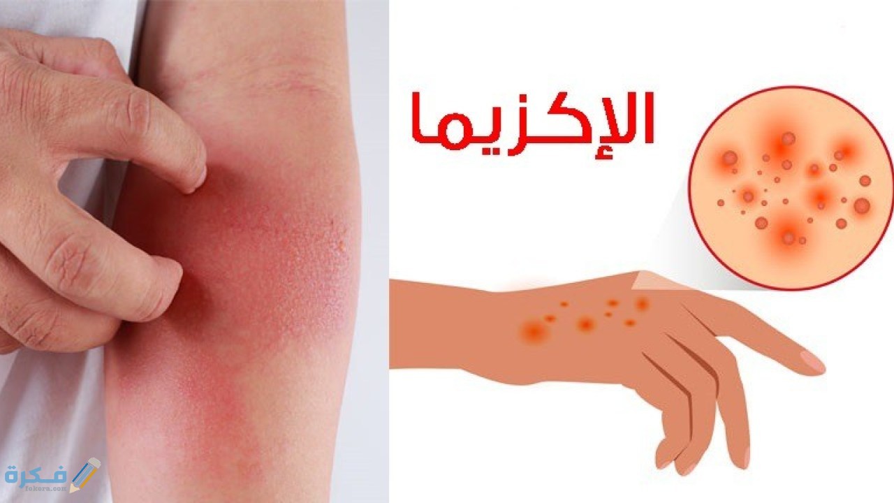 اسباب اكزيما اليدين وانواعها