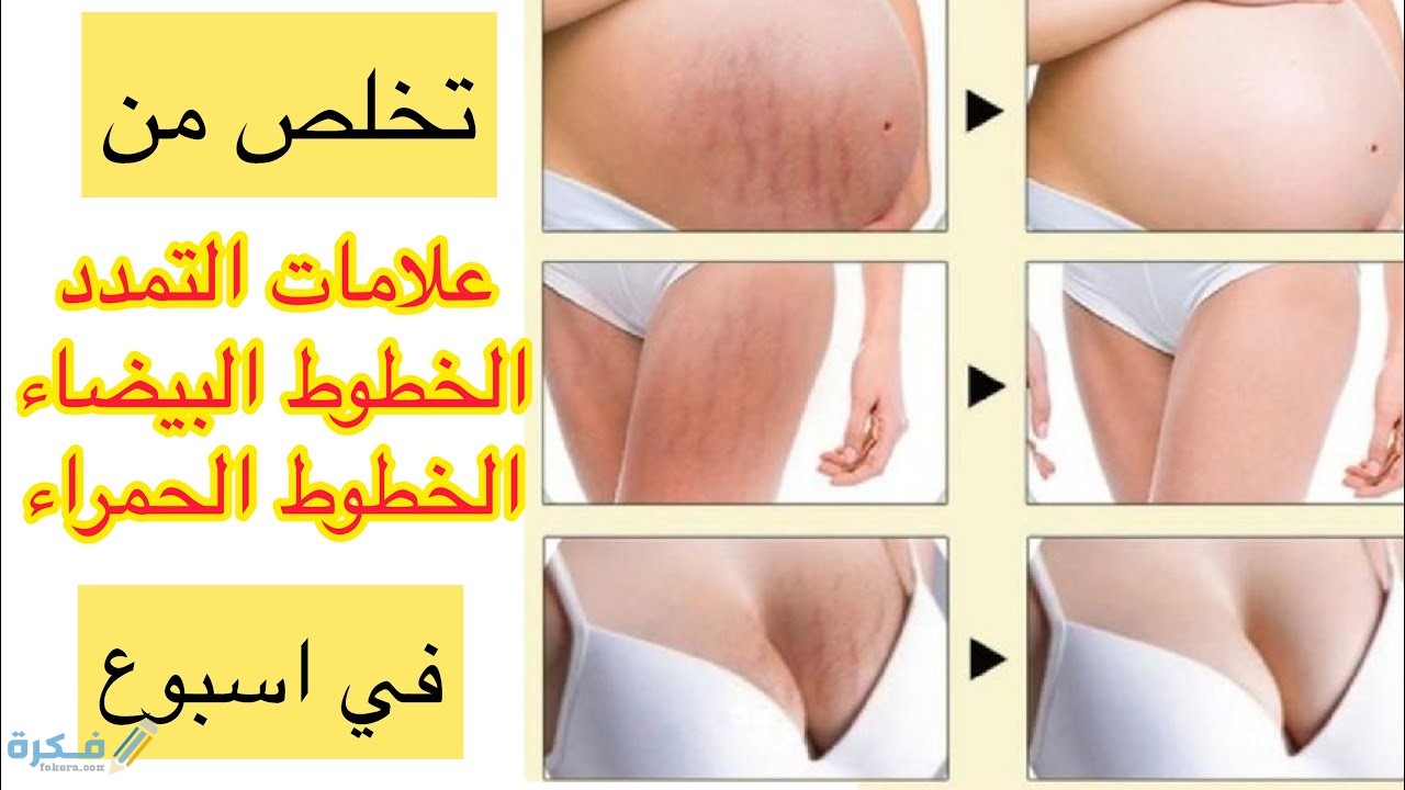 خلطات طبيعيه للتخلص من علامات التمدد الحمراء