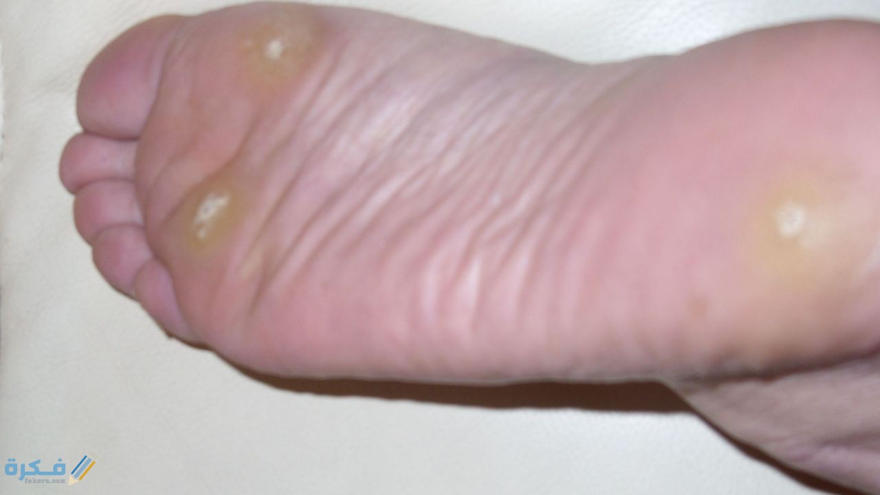 شرح خطوات التخلص من عين السمكة 9 اسباب تكون عين السمكه في القدم