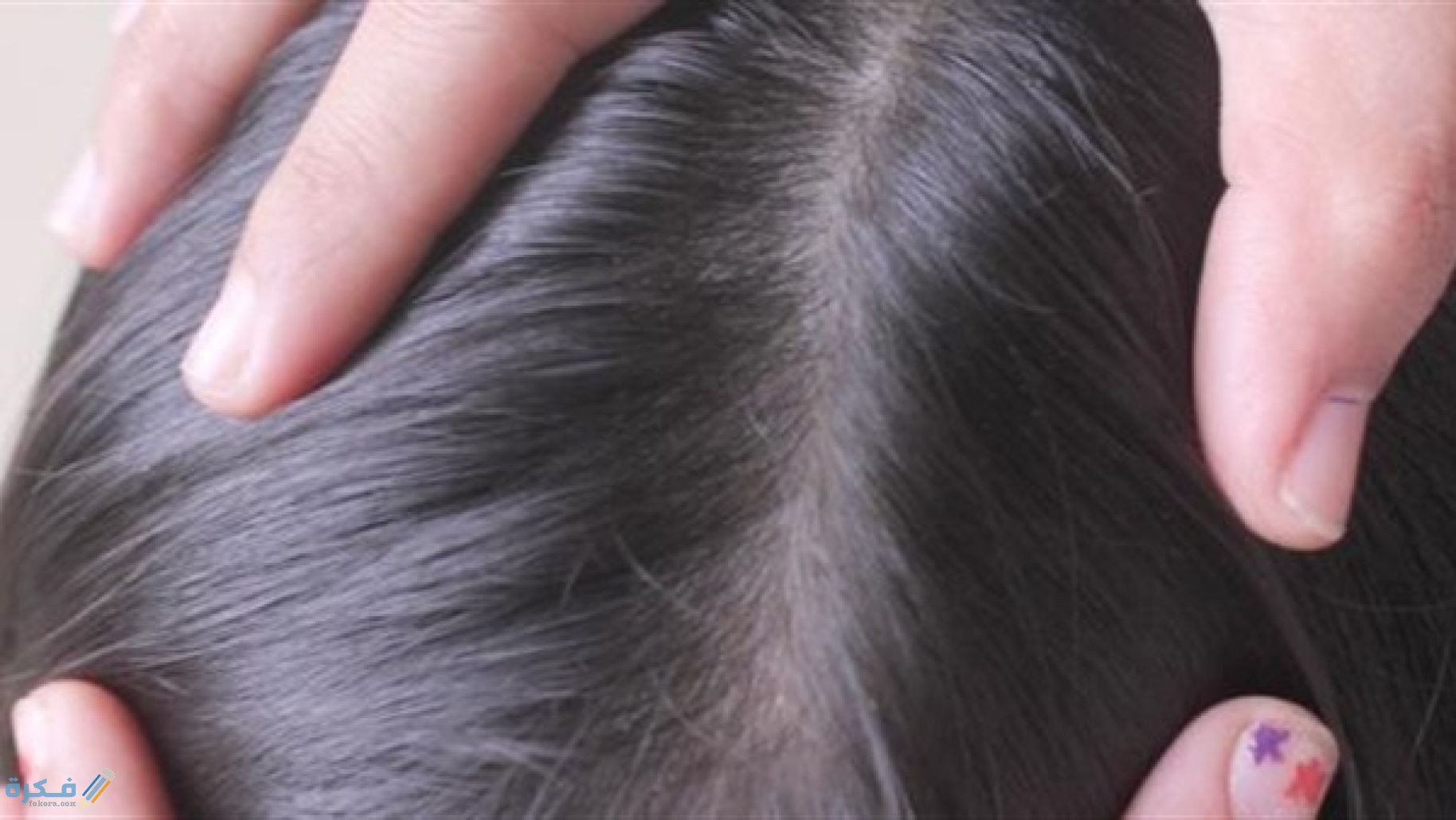 شرح خطوات التخلص من القمل والصيبان في يوم واحد نهائيا 2 طرق-علاج-القمل-والصيبان