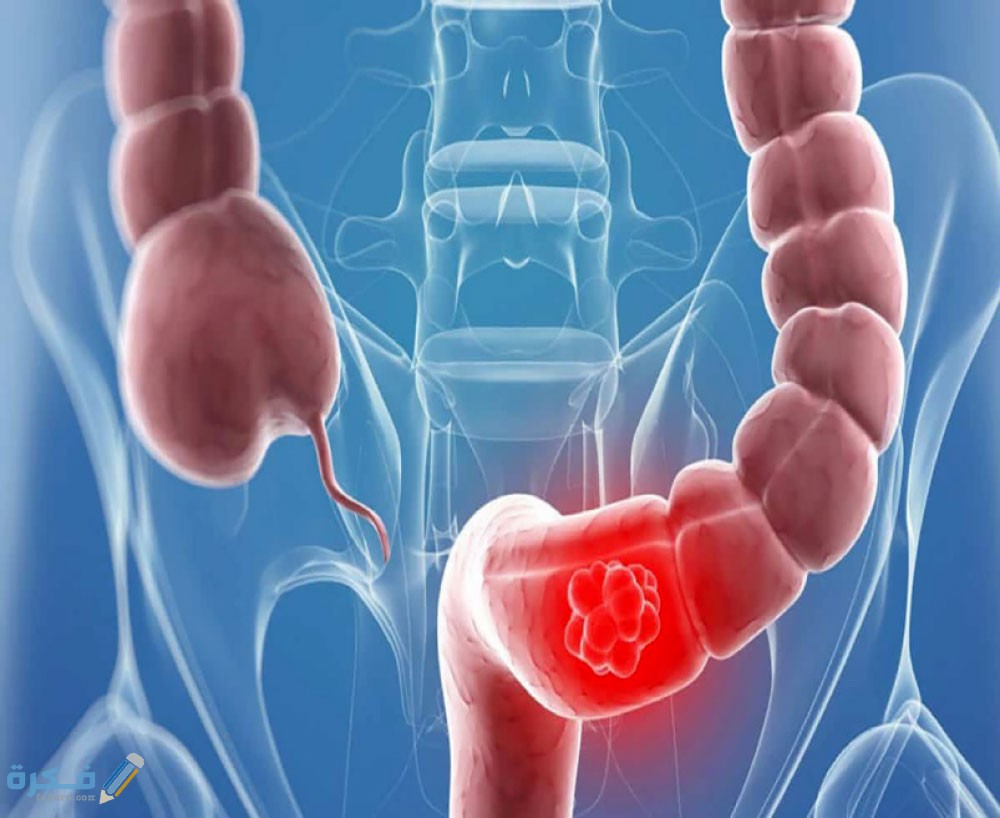 علاج-غازات-البطن-