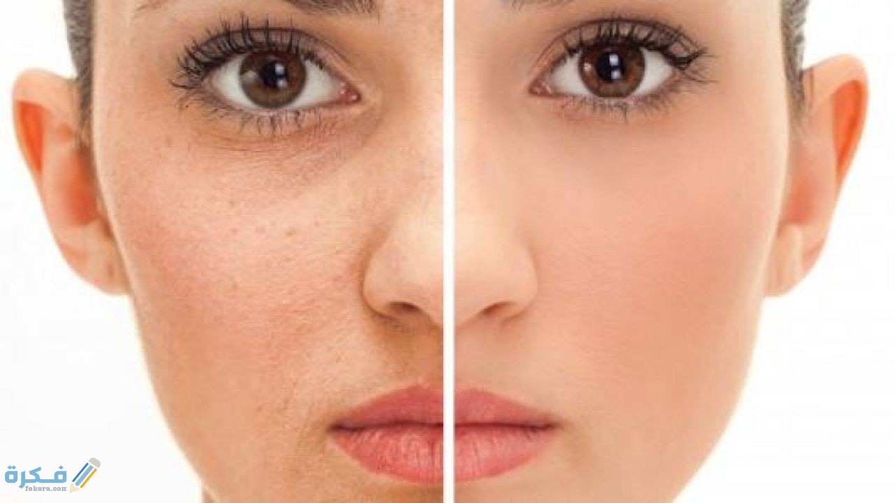 وصفات للتخلص من حب الشباب