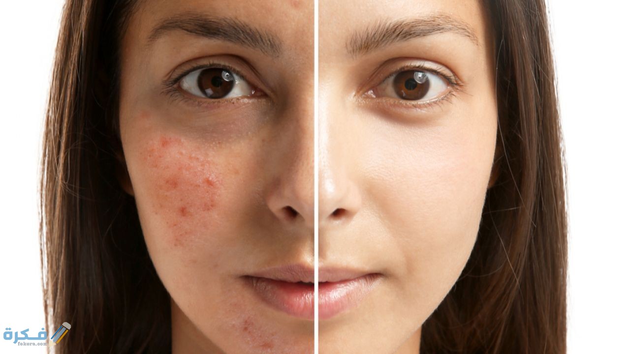 كيفية-التخلص-من-آثار-حب-الشباب