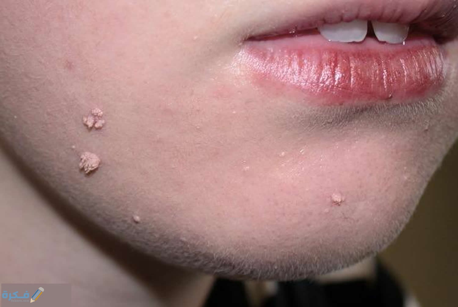 طريقة التخلص من ثاليل الوجه