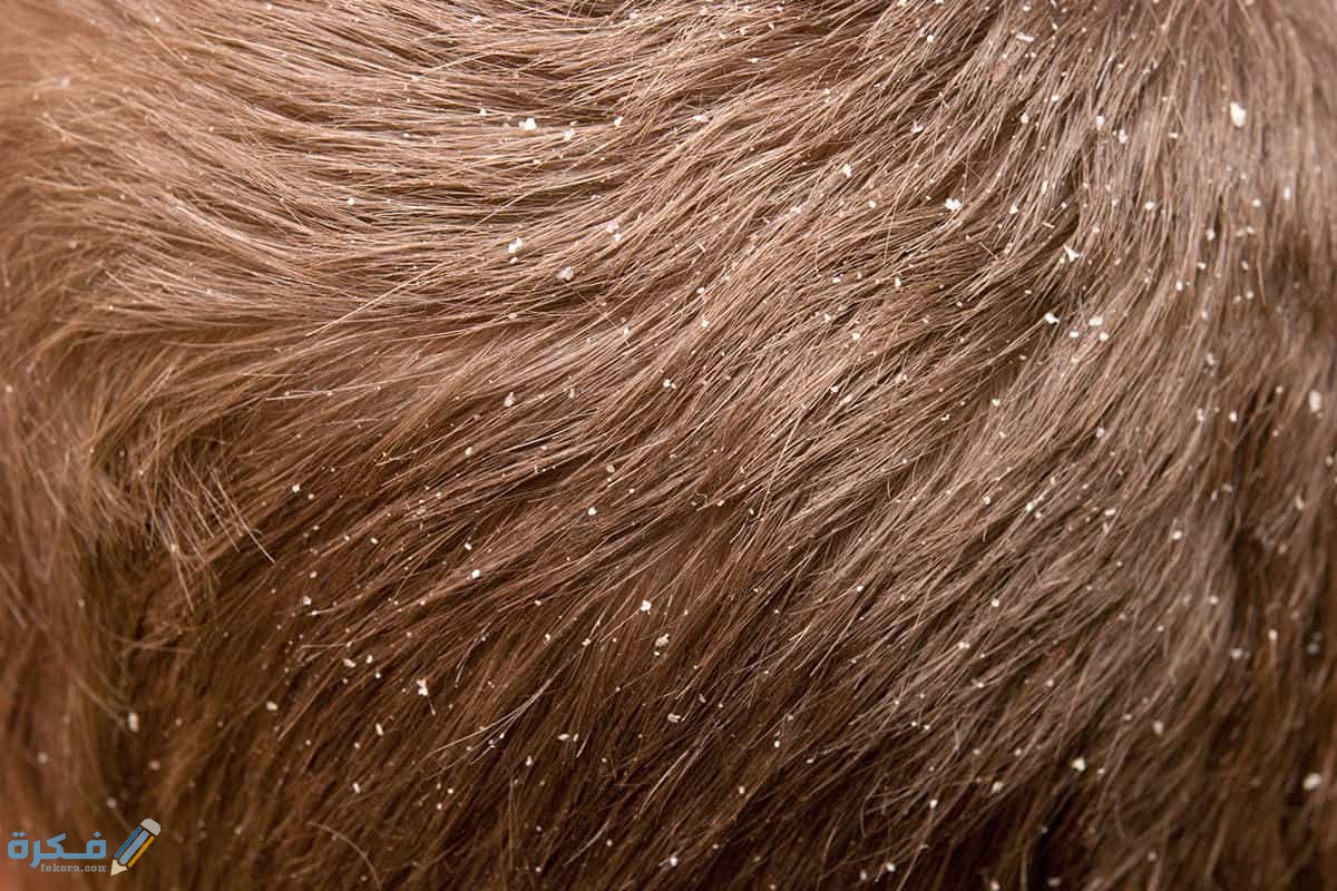 التخلص من صيبان الشعر