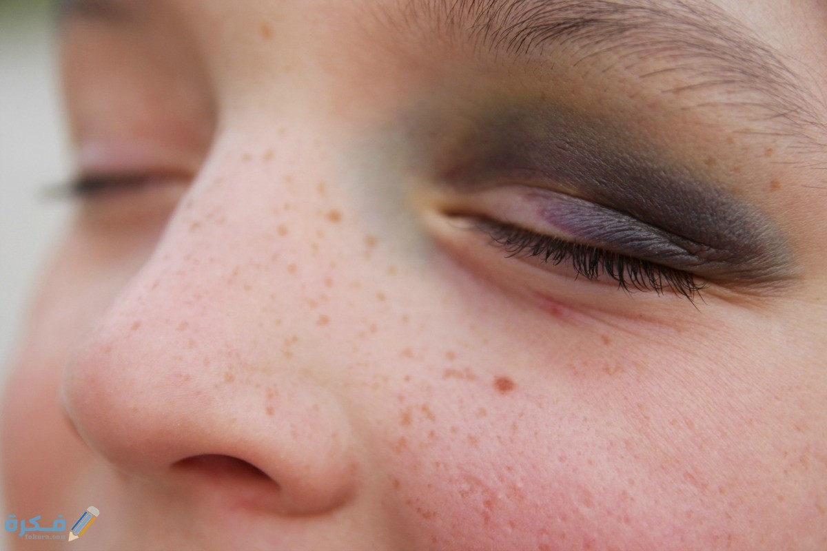 طريقة التخلص من كدمات الوجه