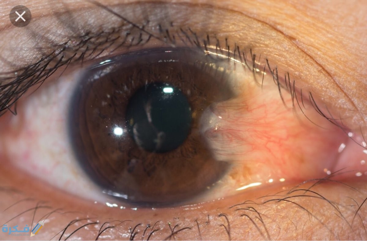طريقة التخلص من ظفر العين