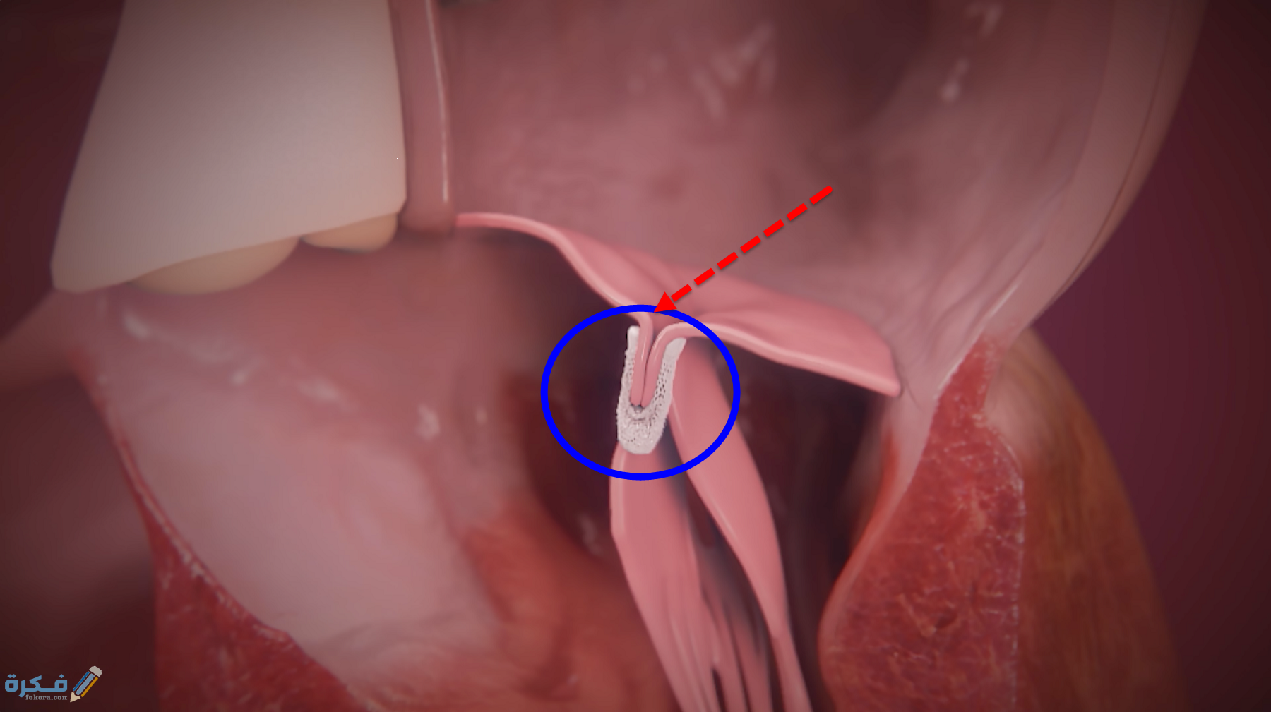 هل ارتخاء الصمام الميترالي يسبب الموت