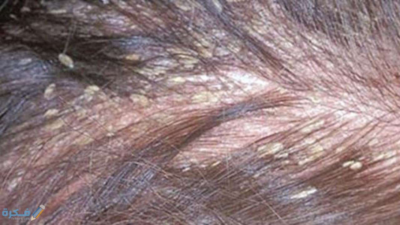 طريقة التخلص من بيض القمل