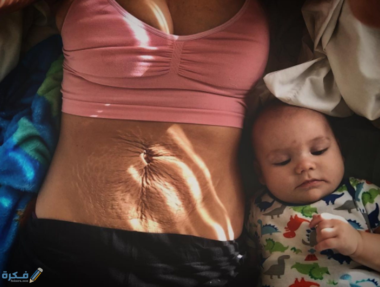 سبب بروز السرة بعد العملية القيصرية