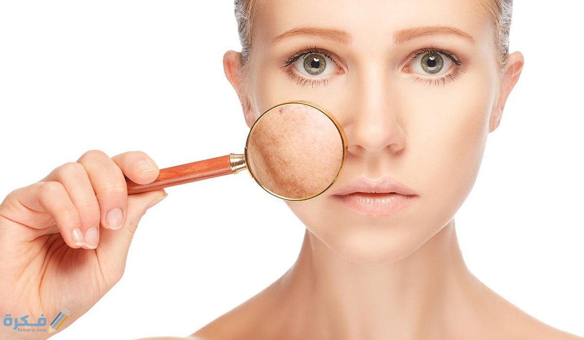 شرح خطوات التخلص من كلف الحمل بعد الولادة 5 علاج كلف الحمل بعد الولادة