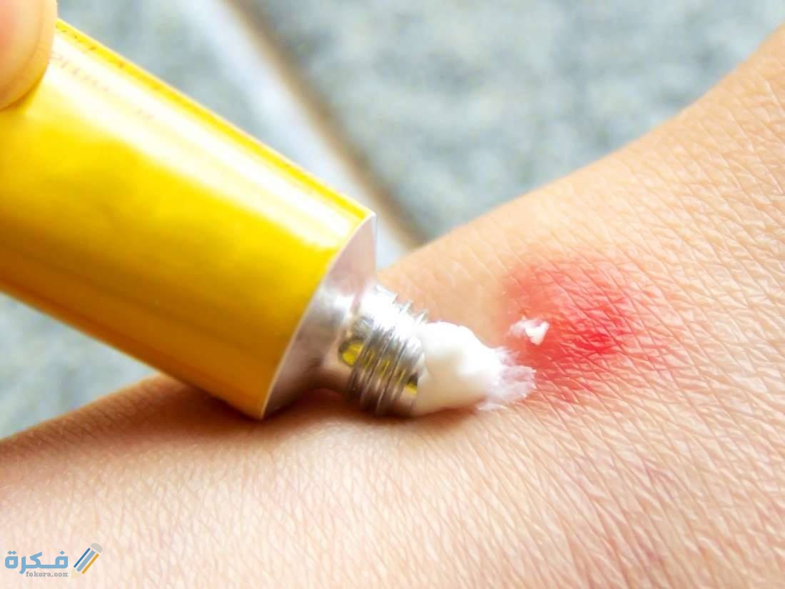 طريقة التخلص من لسعات الناموس