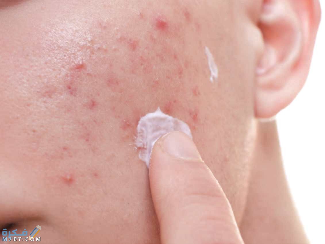 وسائل علاج حب الشباب