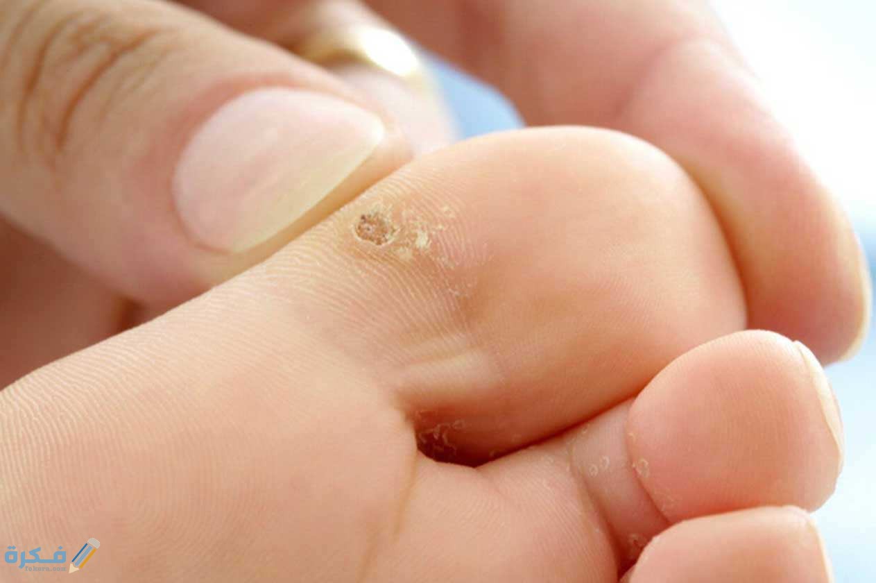 اسماء ادوية لعلاج عين السمكة