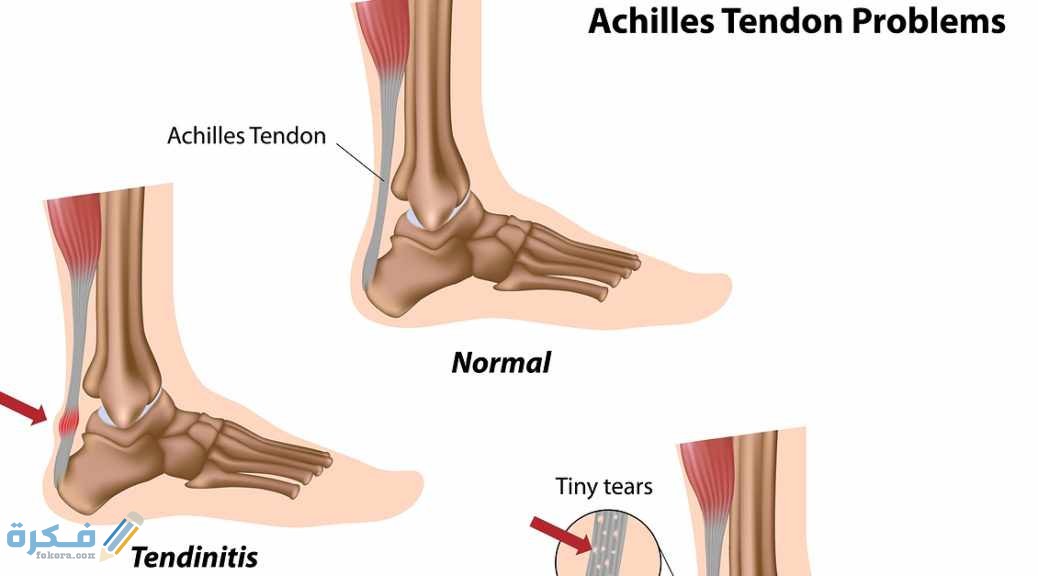اسباب التهاب الاوتار