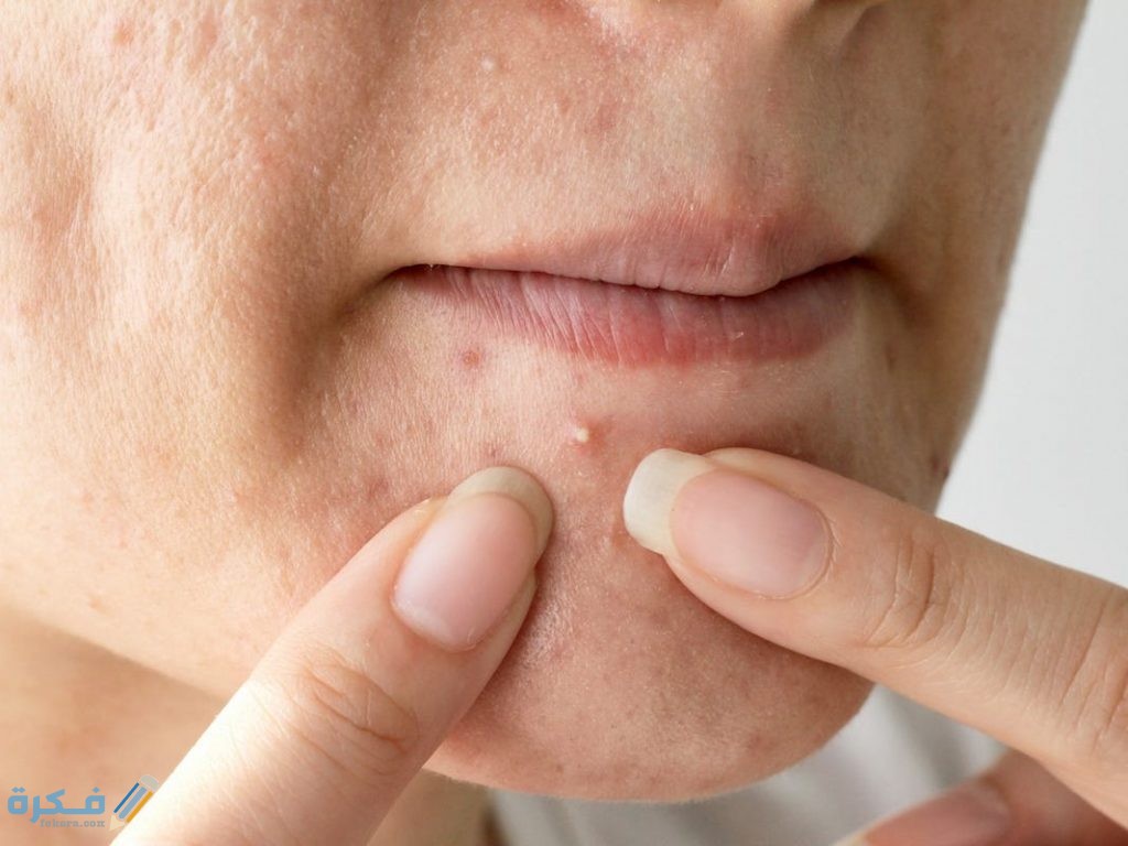 علاج حب الشباب