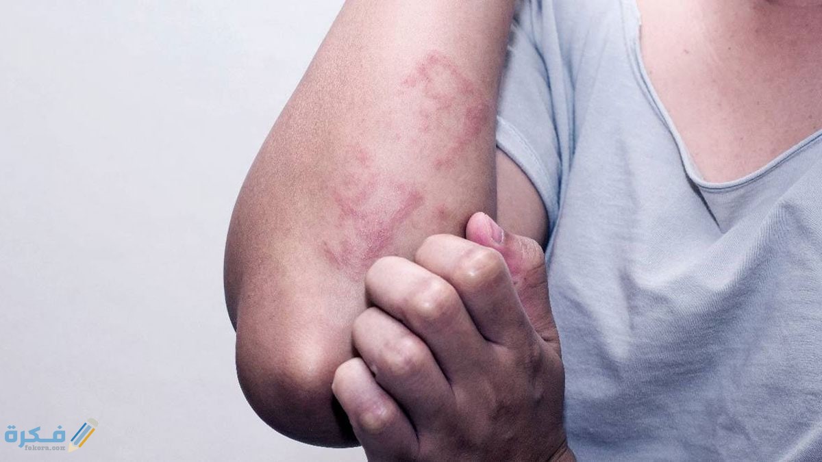 فطريات الجلد