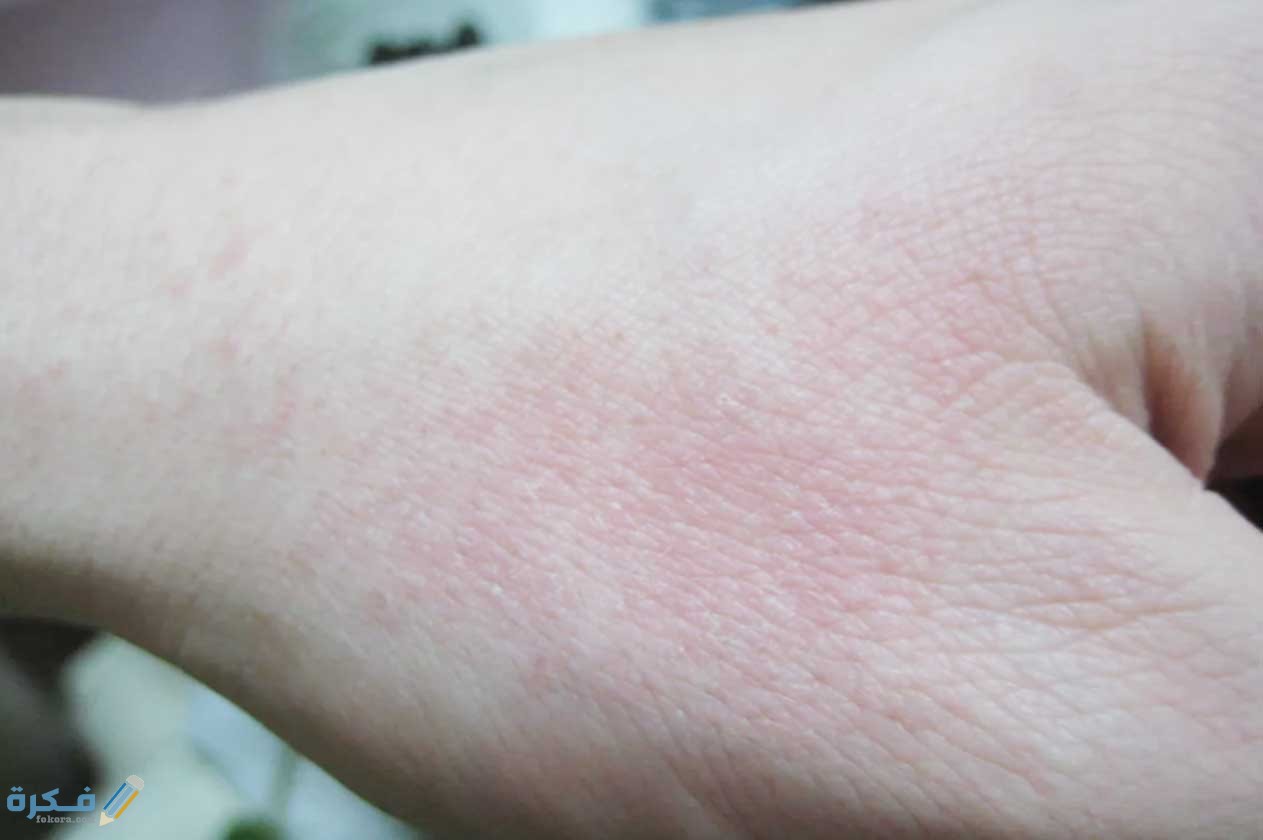 ماهو مضاد الهستامين