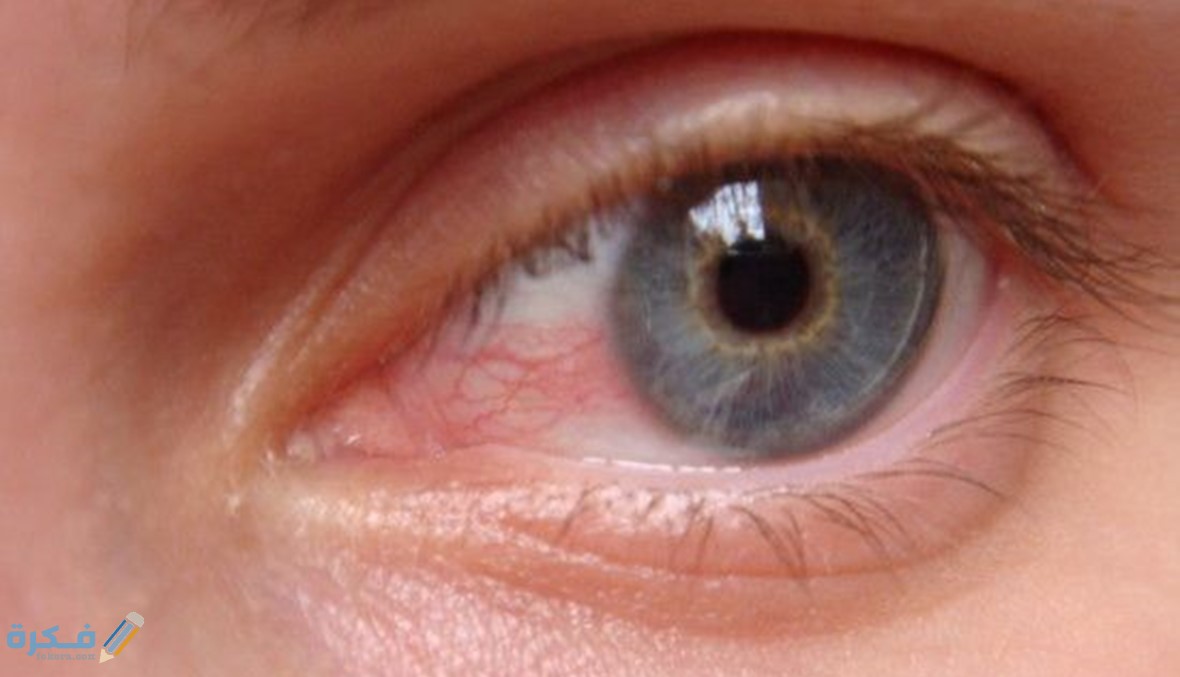 أسباب إفراز الخطوط البيضاء في العين