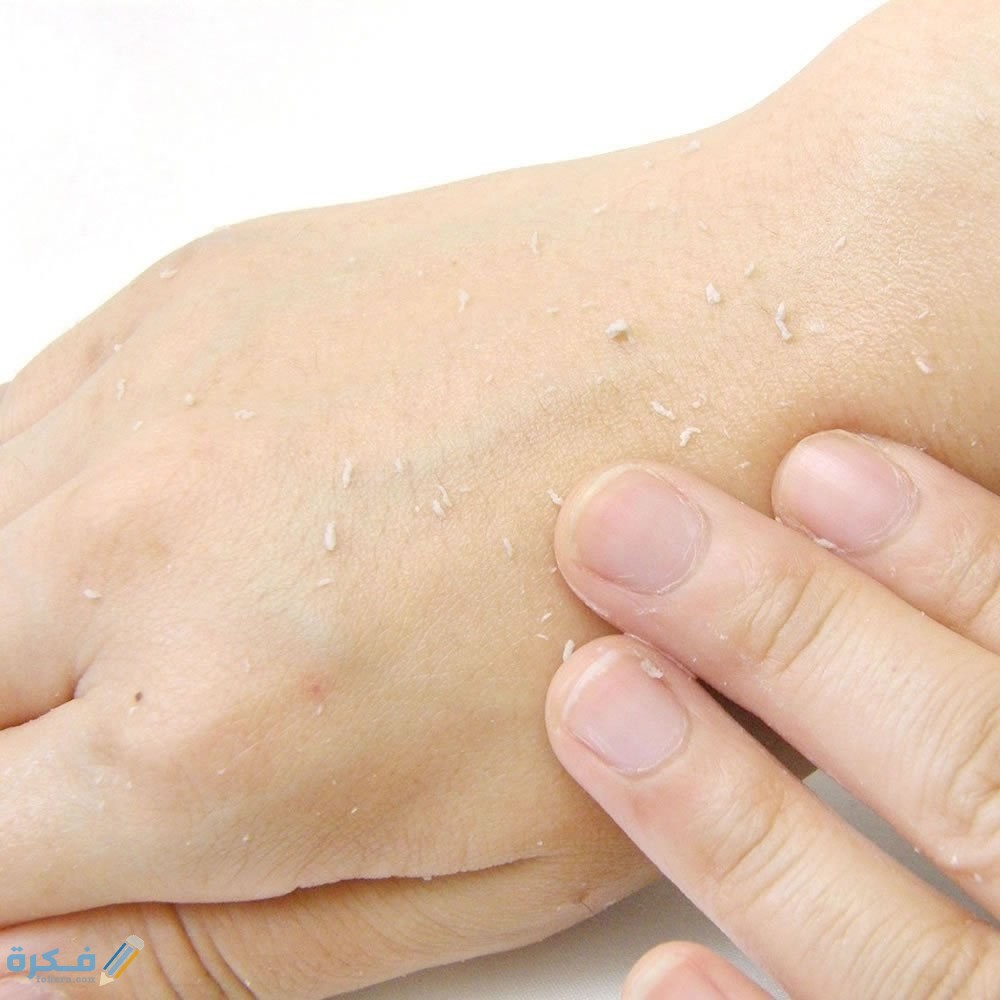 إزالة الجلد الميت