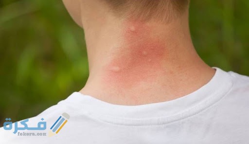 أنواع قرصات الحشرات بالصور