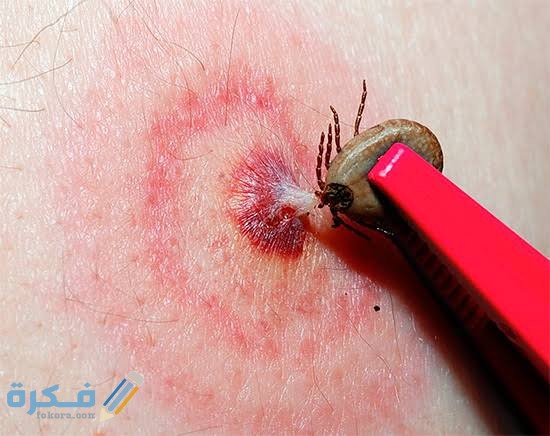 علاج لدغ الحشرات 2 images 2021 11 23T222331.570