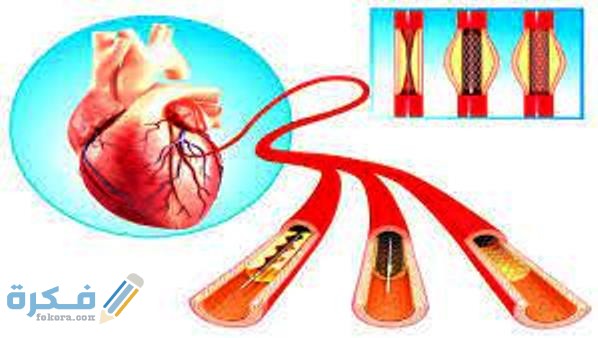 تكلفة عملية قسطرة القلب 14 مفهوم قسطرة القلب