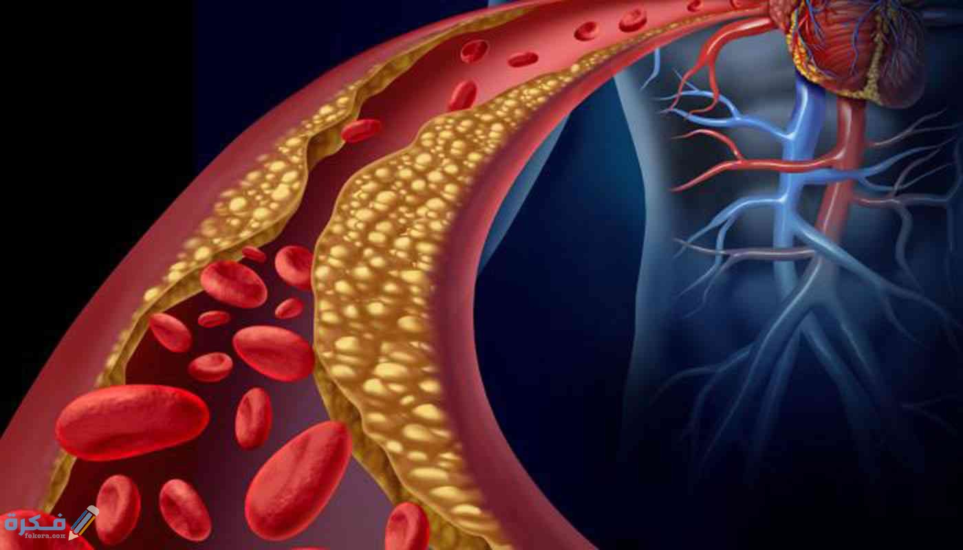 هل ارتفاع الكولسترول يسبب نغزات