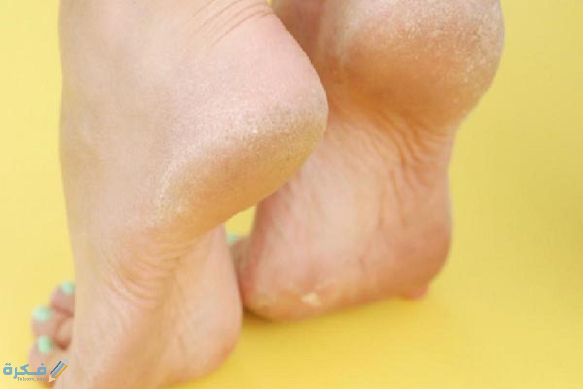 تفسير رؤية تشقق كعب القدم في المنام 1 للتخلص من تشقق كعب القدمين