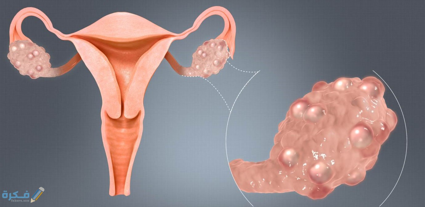 اضرار كيس المبيض على المراة